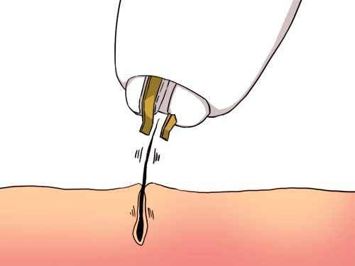 家庭用高周波 電気 脱毛器のおすすめ3選 価格 口コミなど徹底比較 Luluepi